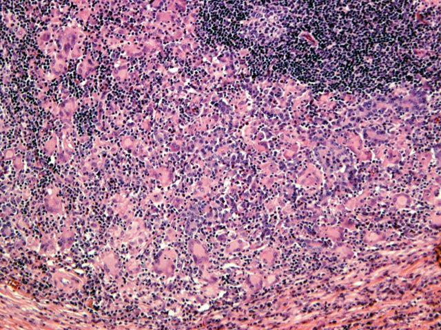 Figura 7. Mediano aumento con visin de clulas gigantes multinucleadas y reaccin histioctica.